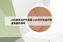 uVb照射治疗牛皮癣 uvb光疗仪治疗银屑有副作用吗