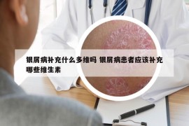 银屑病补充什么多维吗 银屑病患者应该补充哪些维生素