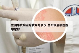 兰州牛皮癣治疗费用是多少 兰州银屑病医院哪家好