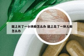 腿上长了一小块癣怎么办 腿上出了一块儿癣怎么办