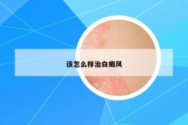 该怎么样治白癜风