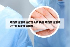 哈西奈德溶液治疗什么皮肤病 哈西奈德溶液治疗什么皮肤病图片