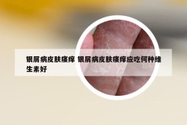 银屑病皮肤瘙痒 银屑病皮肤瘙痒应吃何种维生素好