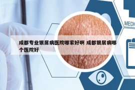 成都专业银屑病医院哪家好啊 成都银屑病哪个医院好