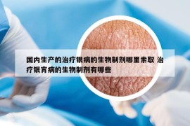 国内生产的治疗银病的生物制剂哪里索取 治疗银宵病的生物制剂有哪些