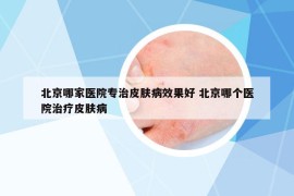 北京哪家医院专治皮肤病效果好 北京哪个医院治疗皮肤病