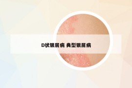 D状银屑病 典型银屑病