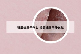 银屑病属于什么 银屑病属于什么科