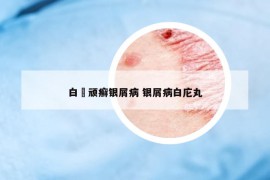 白疕顽癣银屑病 银屑病白庀丸