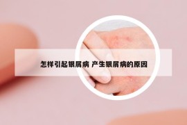 怎样引起银屑病 产生银屑病的原因