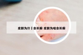 皮肤为什麼会长癣 皮肤为啥会长癣