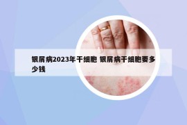 银屑病2023年干细胞 银屑病干细胞要多少钱