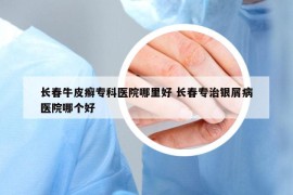 长春牛皮癣专科医院哪里好 长春专治银屑病医院哪个好