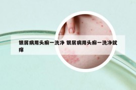 银屑病用头癣一洗净 银屑病用头癣一洗净就痒