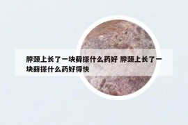 脖颈上长了一块藓搽什么药好 脖颈上长了一块藓搽什么药好得快