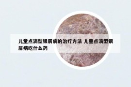 儿童点滴型银屑病的治疗方法 儿童点滴型银屑病吃什么药