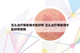 怎么治疗银屑病才能好呢 怎么治疗银屑病才能好呢视频