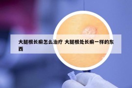 大腿根长癣怎么治疗 大腿根处长癣一样的东西