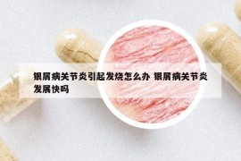 银屑病关节炎引起发烧怎么办 银屑病关节炎发展快吗