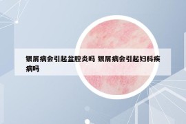 银屑病会引起盆腔炎吗 银屑病会引起妇科疾病吗