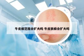 牛皮癣范围会扩大吗 牛皮肤癣会扩大吗