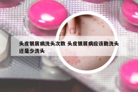 头皮银屑病洗头次数 头皮银屑病应该勤洗头还是少洗头