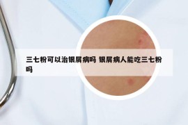 三七粉可以治银屑病吗 银屑病人能吃三七粉吗