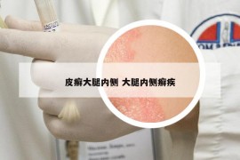 皮癣大腿内侧 大腿内侧癣疾