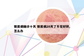 银屑病确诊十天 银屑病20天了不见好转,怎么办