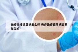 光疗治疗银屑病怎么样 光疗治疗银屑病容易复发吗