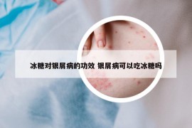 冰糖对银屑病的功效 银屑病可以吃冰糖吗