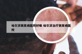 哈尔滨银屑病医院好嘛 哈尔滨治疗银屑病医院