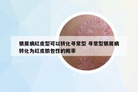 银屑病红皮型可以转化寻常型 寻常型银屑病转化为红皮脓包性的概率