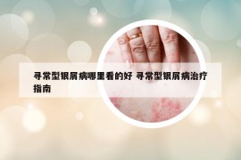 寻常型银屑病哪里看的好 寻常型银屑病治疗指南