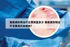 银屑病生物治疗总费用是多少 银屑病生物治疗主要用药有哪些?