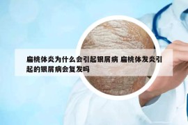 扁桃体炎为什么会引起银屑病 扁桃体发炎引起的银屑病会复发吗