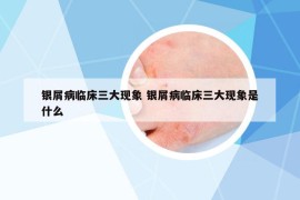 银屑病临床三大现象 银屑病临床三大现象是什么