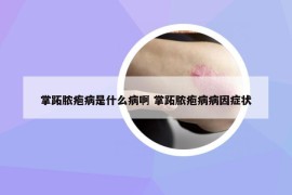 掌跖脓疱病是什么病啊 掌跖脓疱病病因症状