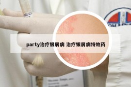 party治疗银屑病 治疗银屑病特效药