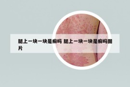 腿上一块一块是癣吗 腿上一块一块是癣吗图片