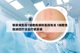 银屑病免疫T细胞疾病和基因有关 t细胞免疫调控疗法治疗银屑病