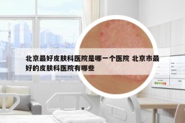 北京最好皮肤科医院是哪一个医院 北京市最好的皮肤科医院有哪些
