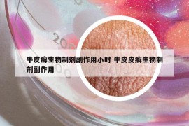 牛皮癣生物制剂副作用小时 牛皮皮癣生物制剂副作用