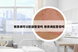 银屑病可以脸部整容吗 银屑病能整容吗