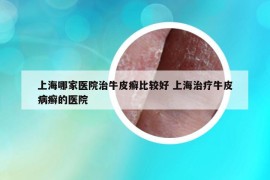 上海哪家医院治牛皮癣比较好 上海治疗牛皮病癣的医院