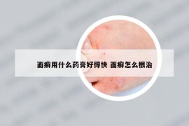 面癣用什么药膏好得快 面癣怎么根治