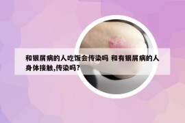 和银屑病的人吃饭会传染吗 和有银屑病的人身体接触,传染吗?