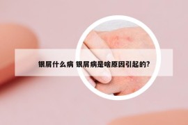 银屑什么病 银屑病是啥原因引起的?