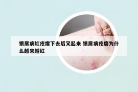 银屑病红疙瘩下去后又起来 银屑病疙瘩为什么越来越红