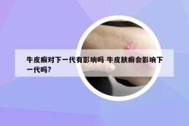 牛皮癣对下一代有影响吗 牛皮肤癣会影响下一代吗?